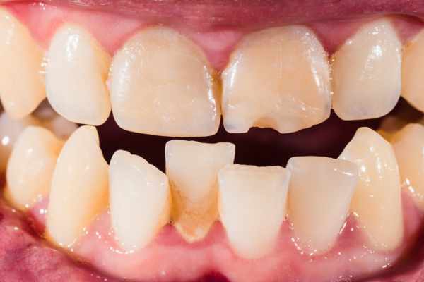 Penyakit Gangguan pada Gigi Mulut dan Bagaimana Pencegahannya